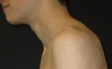 Lateral clinical photograph showing forward head posture in a pectus patient