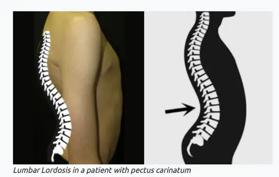 Diagram showing lumbar lordosis in pectus patient