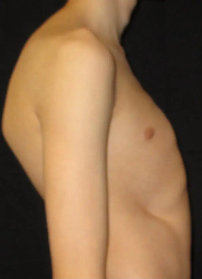 Lateral view showing postural changes associated with pectus deformity