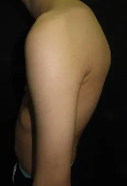 Side view showing rounded shoulder position and anterior projection