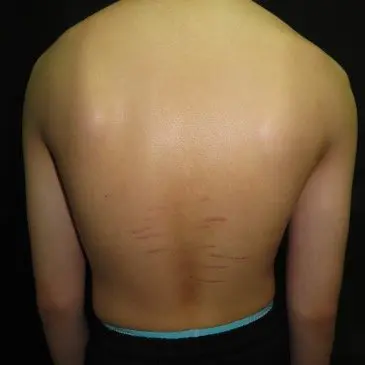 Posterior view showing scapular protraction and stretch marks in pectus patient