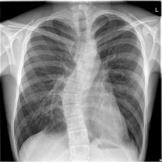 PA chest X-ray showing mild scoliosis associated with pectus deformity