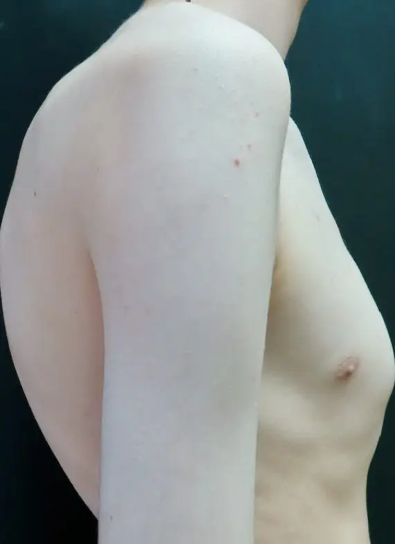 Clinical photograph showing thoracic kyphosis in a pectus patient — lateral view