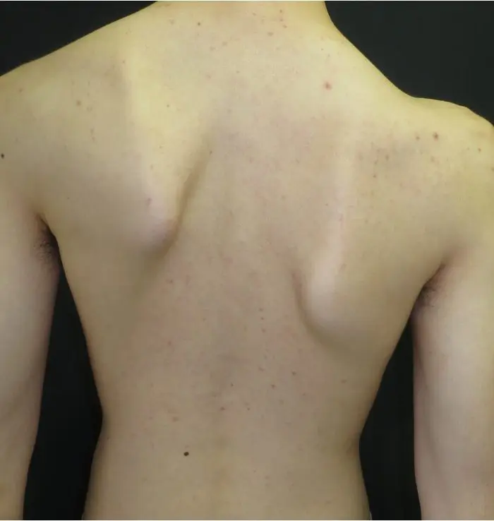 Posterior clinical photograph showing uneven shoulder height in asymmetric pectus