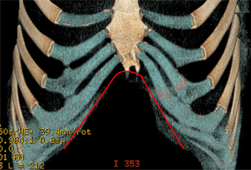 Rib Flare  Pectus Clinic