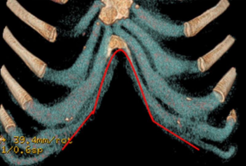 Variation in the shape of the costal margin