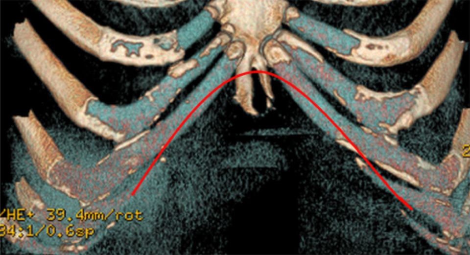 Variation in the shape of the costal margin