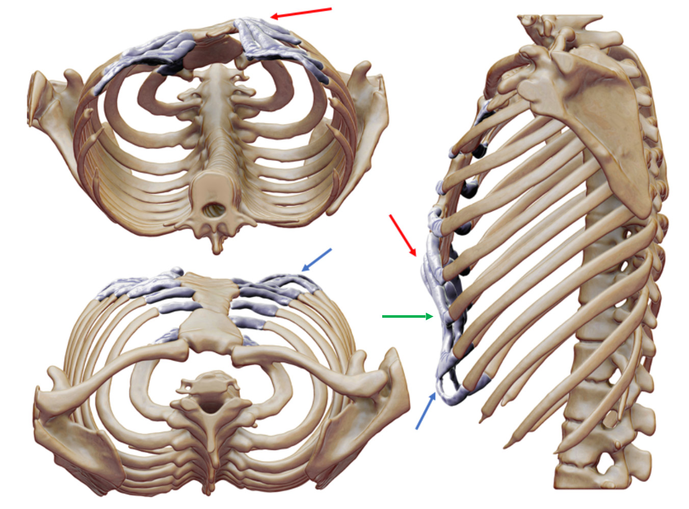 Chest CT reconstruction of young woman with left sided pectus carinatum