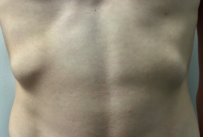 Rib flaring and Pectus Excavatum