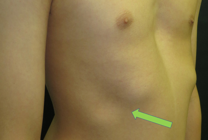 Rib flaring and Pectus Excavatum