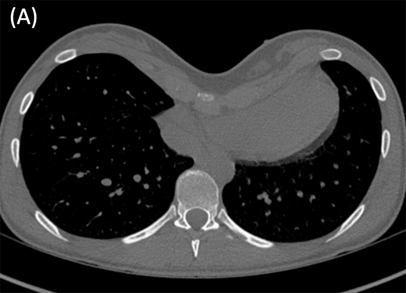 Rib flaring and Pectus Excavatum