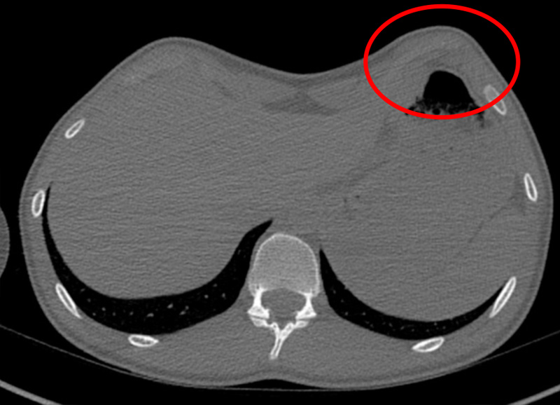 Rib flaring and Pectus Excavatum