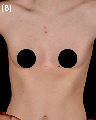 Rib flaring and Pectus Excavatum