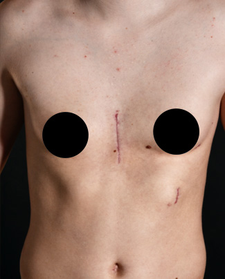 Rib flaring and Pectus Excavatum