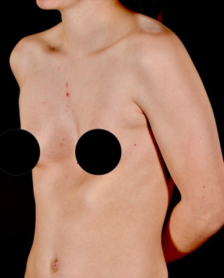 Rib flaring and Pectus Excavatum