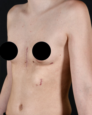 Rib flaring and Pectus Excavatum