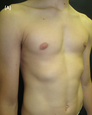 Pectus Excavatum