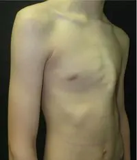 Pectus carinatum — clinical example