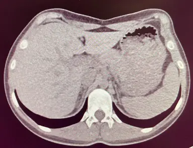 Axial CT — left-sided rib flare