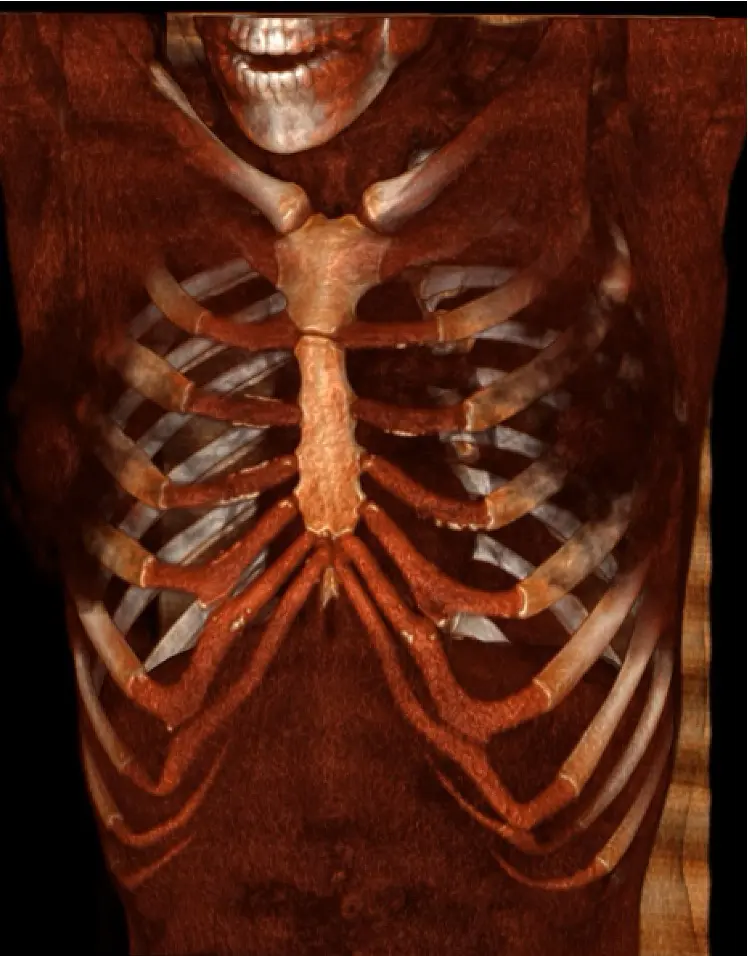3D CT reconstruction — bilateral rib flare with bilateral slipping rib syndrome