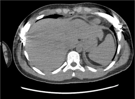 CT scan — rib flare with pectus deformity