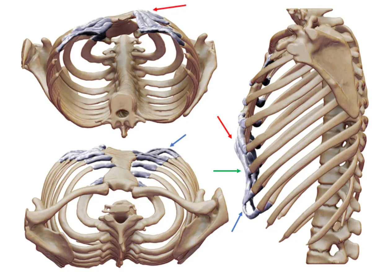 3D reconstruction showing left-sided pectus carinatum and rib flare