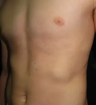 Mild left-sided rib flare