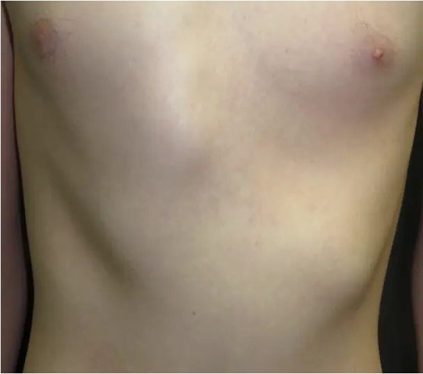 Moderate bilateral rib flare with right cleft
