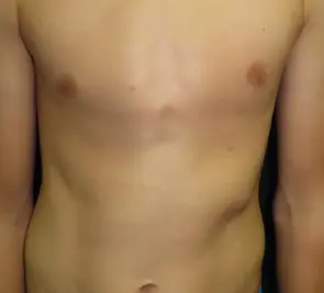 Moderate bilateral rib flare, shelf-like left