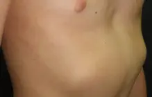 Rib flare — clinical observation example