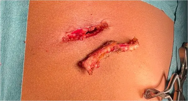 Costal cartilage resection — surgical image
