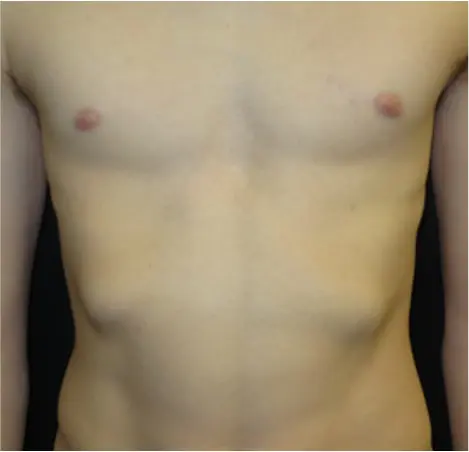 Clinical example of rib flare — lower rib prominence