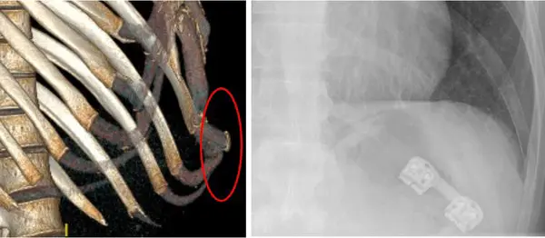 Rib stabilisation — 3D CT reconstruction and postoperative X-ray with hardware