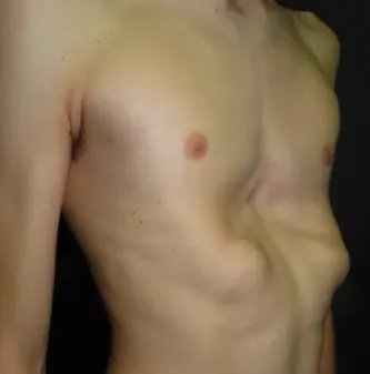 Severe bilateral rib flare with pectus excavatum