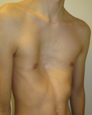 Severe asymmetric Pectus excavatum with a broad deformity and moderate rib flaring