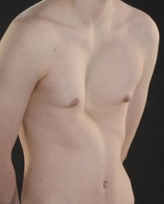 Severe asymmetric pectus excavatum with a trench like deformity and some rib flattening