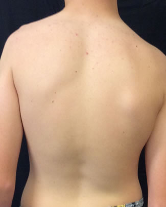 Shoulder tilt with lateral rotation of the scapula