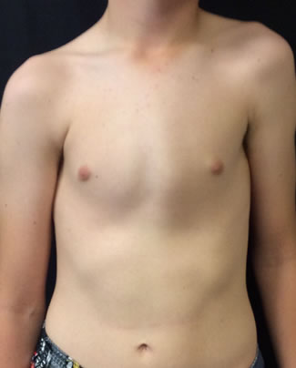 Shoulder tilt with lateral rotation of the scapula with severe pectus carinatum
