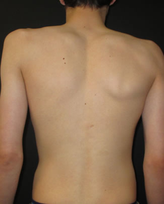 Pectus Posture Pectus Clinic