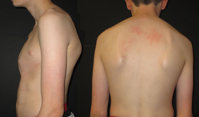 Stooped shoulders with pectus carinatum