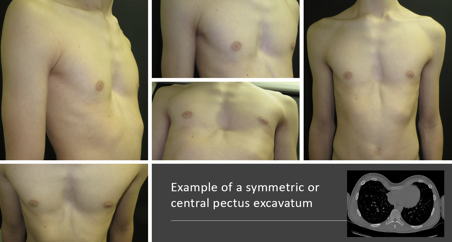 Example of a symmetric or central pectus excavatum