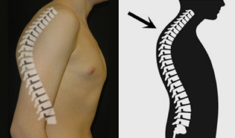 Thoracic Kyphosis in a patient with pectus carinatum