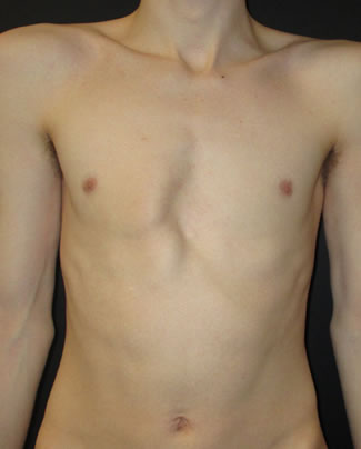 Uneven shoulders pectus deformities