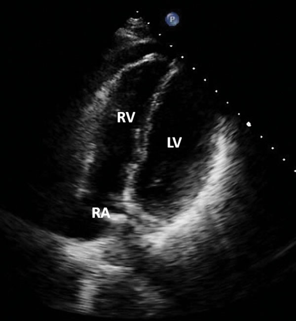 Echocardiogram of heart