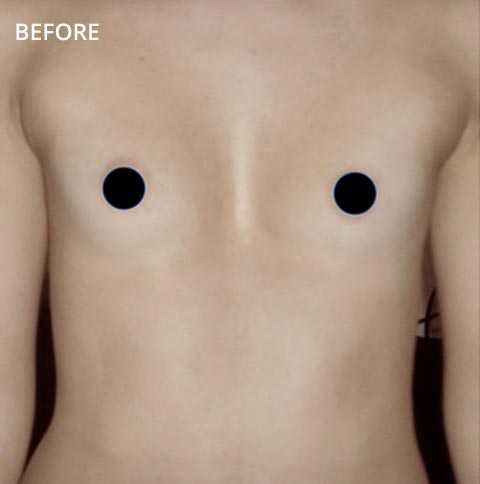 image gallery pectus clinic
