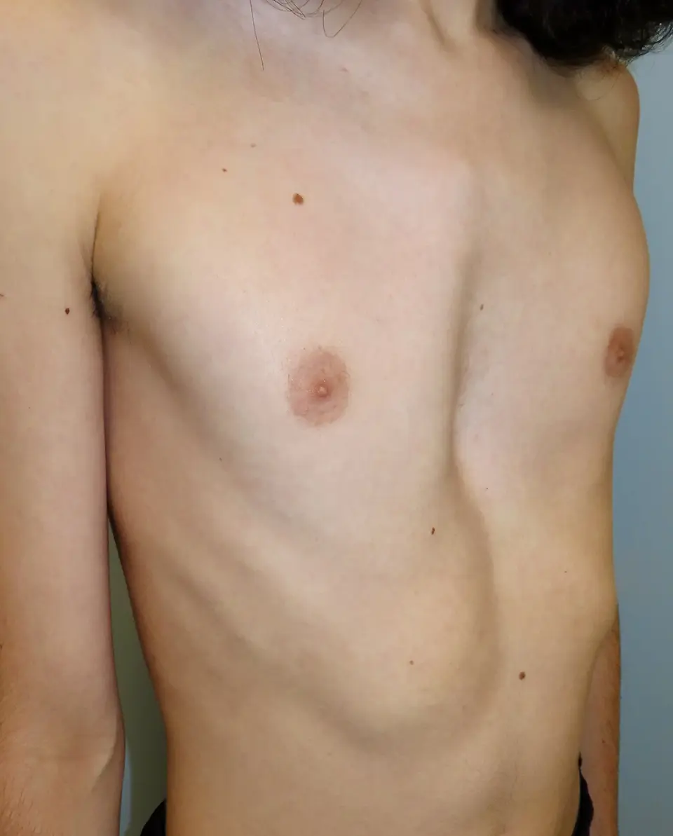 Mixed & Asymmetrical Deformity