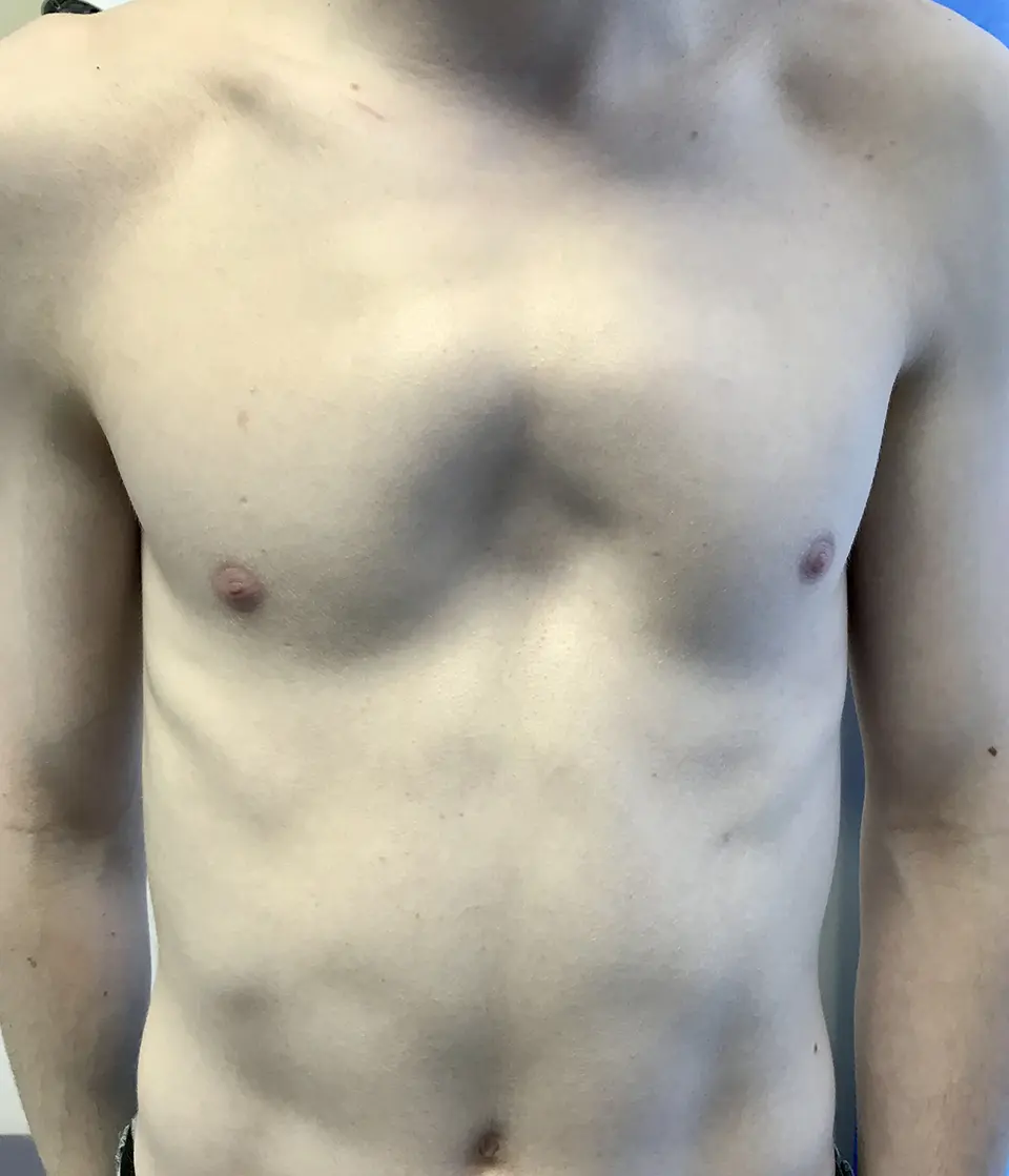 Pectus Arcuatum