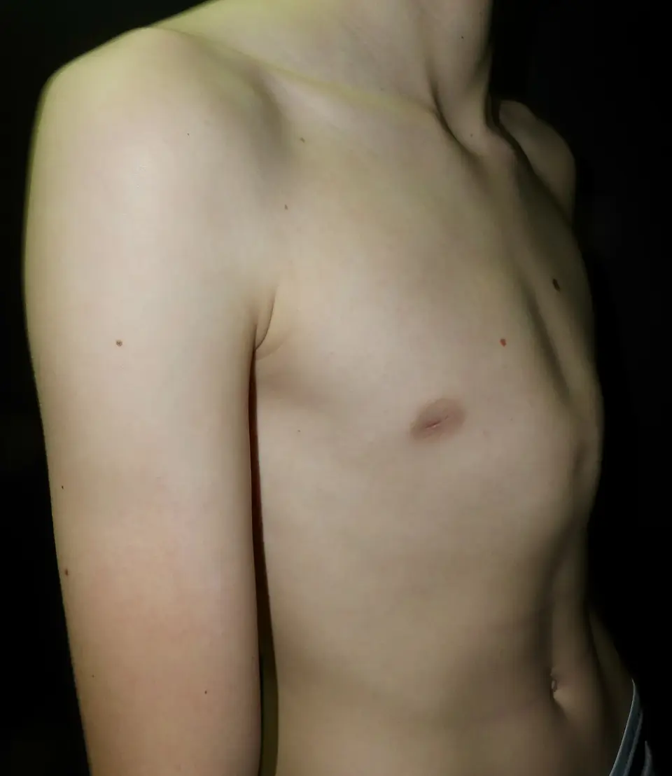 Pectus Carinatum