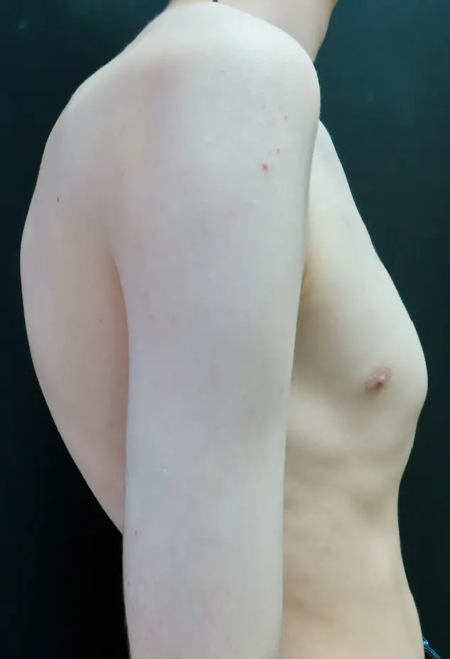 Pectus Posture