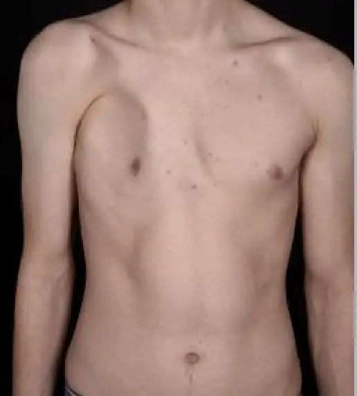 Poland Syndrome